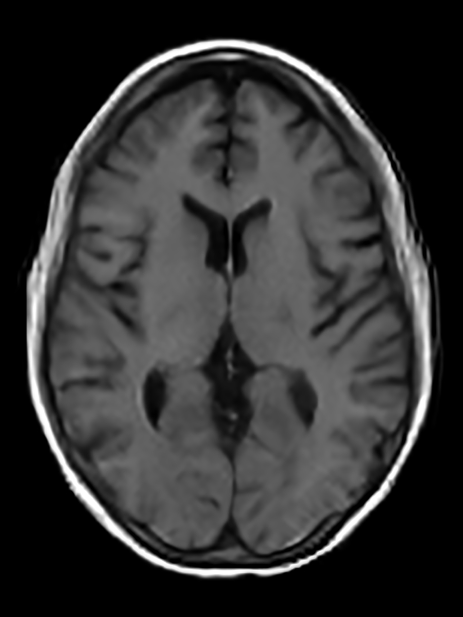 T1 (Gray/White)