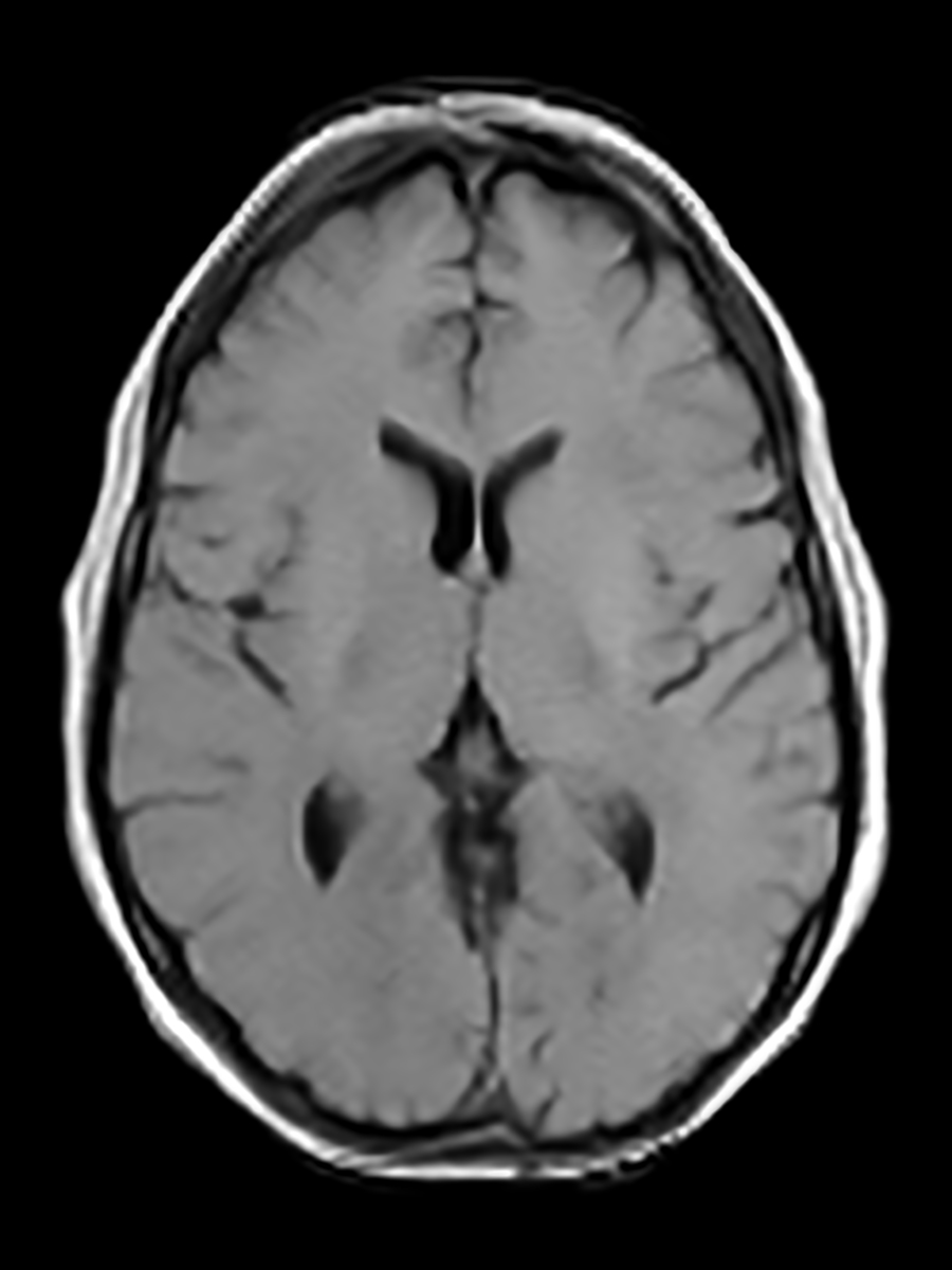 T1 (Standard)