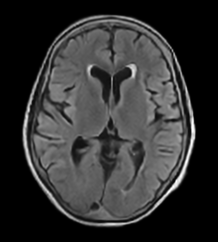 Microvascular Disease