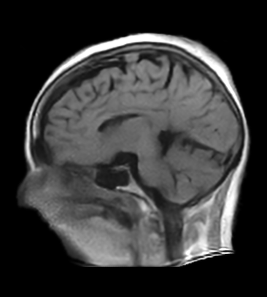 Tumor Routine Follow-up