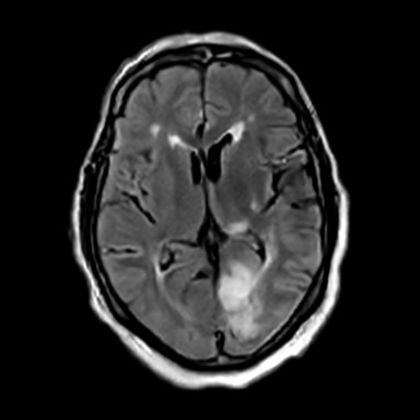 v2-stroke-webinar-request-a-clinical-image-review