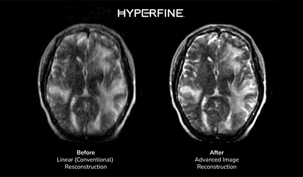 Advanced Image Reconstruction&mdash;deep learning&nbsp;technology.